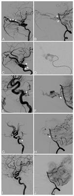 Case report: Spontaneous carotid-cavernous fistula associated with persistent primitive trigeminal artery aneurysm rupture